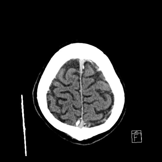 File:Cerebral abscess with ventriculitis (Radiopaedia 78965-91877 A 42).jpg