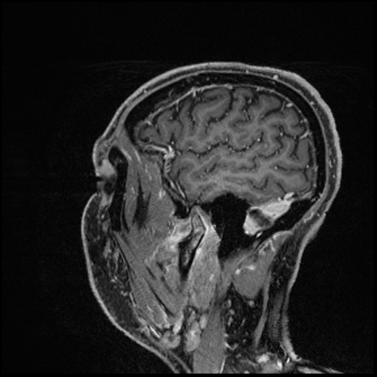 Cerebral abscess with ventriculitis (Radiopaedia 78965-91878 Sagittal T1 C+ 149).jpg
