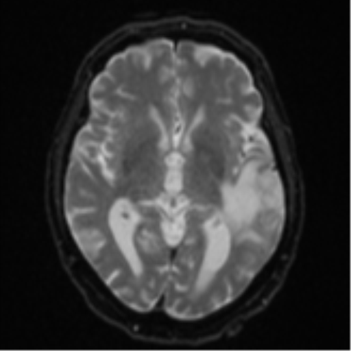 Cerebral abscesses- medically managed (Radiopaedia 45183-49179 Axial DWI 14).png