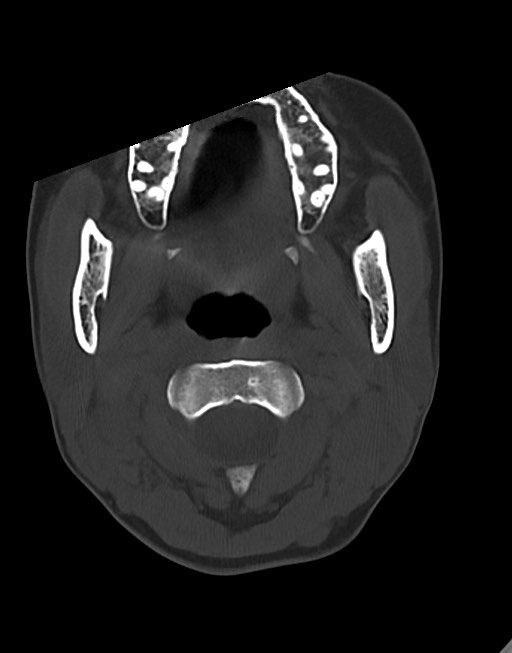 Cerebral abscesses (Radiopaedia 70458-80568 Axial bone window 4).jpg