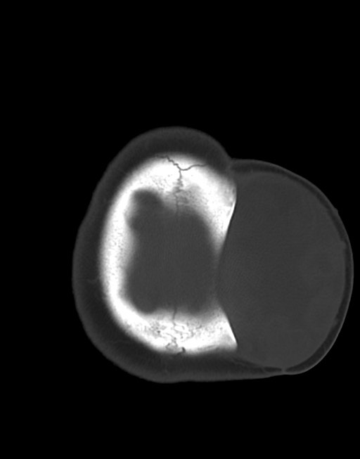 Cerebral abscesses (Radiopaedia 70458-80568 Axial bone window 54).jpg