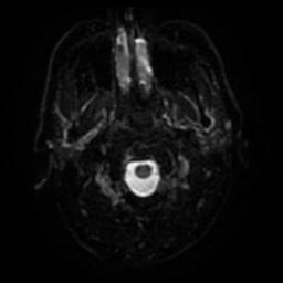 Cerebral amyloid angiopathy (Radiopaedia 28698-28978 Axial DWI 29).jpg