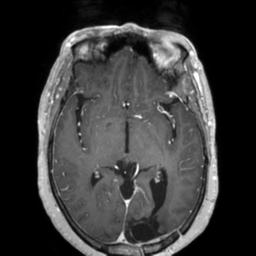 Cerebral amyloid angiopathy (Radiopaedia 29129-29518 Axial T1 C+ 71).jpg