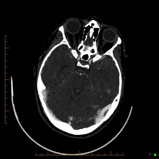 Cerebral arteriovenous malformation (AVM) (Radiopaedia 78162-90706 Axial CTA 104).jpg