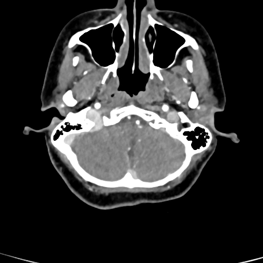 Cerebral arteriovenous malformation (Radiopaedia 73830-84645 B 86).jpg