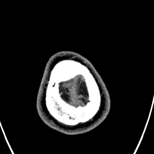 Cerebral arteriovenous malformation (Radiopaedia 78188-90746 Axial C+ delayed 166).jpg