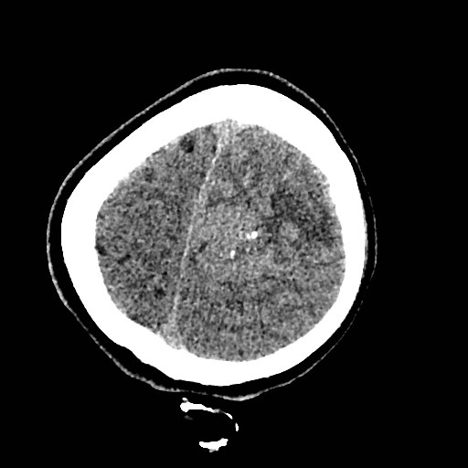 Cerebral arteriovenous malformation (Radiopaedia 79677-92887 Axial non-contrast 48).jpg