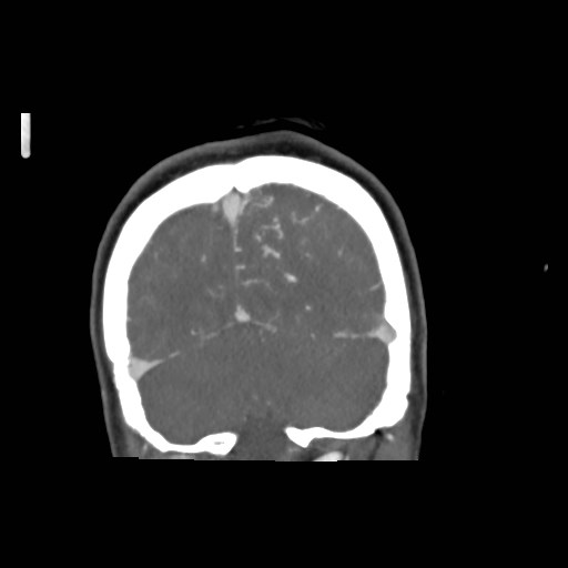 File:Cerebral arteriovenous malformation (Radiopaedia 79677-92888 B 42).jpg
