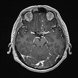 Cerebral arteriovenous malformation (Radiopaedia 84015-99245 Axial T1 C+ 64).jpg