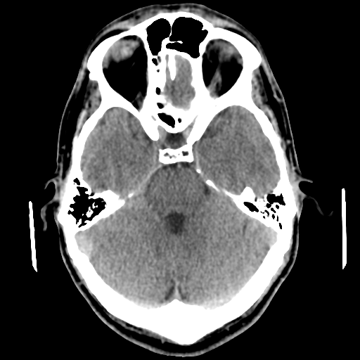 File:Cerebral arteriovenous malformation (Spetzler-Martin grade 2) (Radiopaedia 41262-44076 Axial non-contrast 19).png
