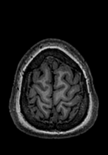 Cerebral arteriovenous malformation at posterior body of corpus callosum (Radiopaedia 74111-84925 Axial T1 16).jpg