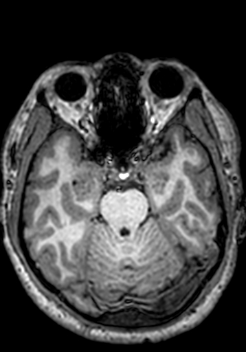 Cerebral arteriovenous malformation at posterior body of corpus callosum (Radiopaedia 74111-84925 Axial T1 207).jpg