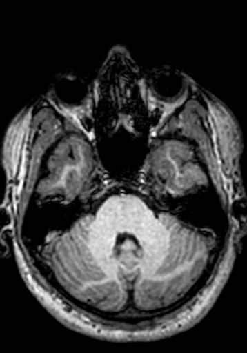 File:Cerebral arteriovenous malformation at posterior body of corpus callosum (Radiopaedia 74111-84925 Axial T1 234).jpg
