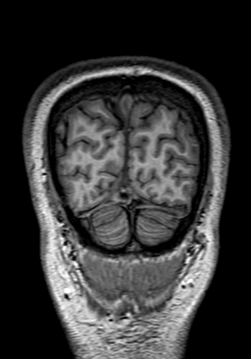 Cerebral arteriovenous malformation at posterior body of corpus callosum (Radiopaedia 74111-84925 Coronal T1 320).jpg