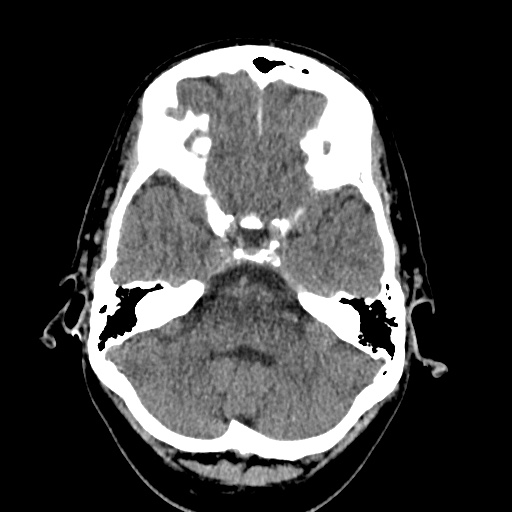 Cerebral arteriovenous malformation with lobar hemorrhage (Radiopaedia 35598-37117 Axial non-contrast 12).jpg