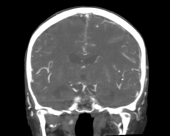 Cerebral arteriovenous malformation with lobar hemorrhage (Radiopaedia 44725-48511 A 30).png