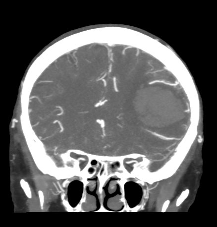 Cerebral arteriovenous malformation with lobar hemorrhage (Radiopaedia 44725-48511 B 19).png