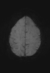 File:Cerebral cavernoma and development venous anomaly (Radiopaedia 37603-39482 Axial SWI MIP 26).png