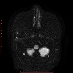 File:Cerebral cavernous malformation (Radiopaedia 26177-26306 Axial DWI 4).jpg