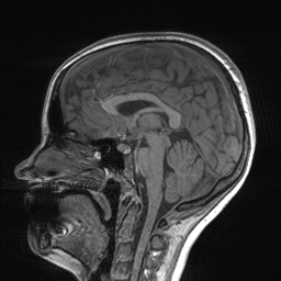 File:Cerebral cavernous venous malformation (Radiopaedia 70008-80021 Sagittal T1 38).jpg
