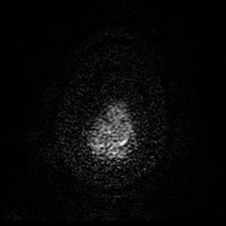 Cerebral cavernous venous malformation (Zabramski type II) (Radiopaedia 85511-101198 Axial DWI 99).jpg