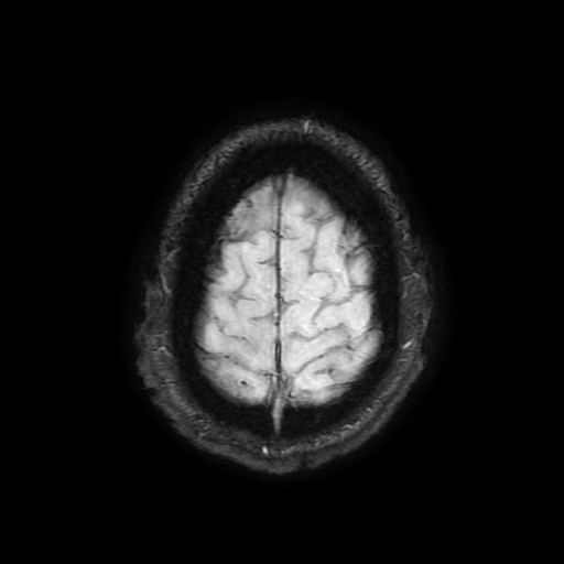 Cerebral cavernous venous malformation (Zabramski type II) (Radiopaedia 85511-101198 Axial SWI 105).jpg