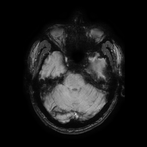 Cerebral cavernous venous malformation (Zabramski type II) (Radiopaedia 85511-101198 Axial SWI 44).jpg