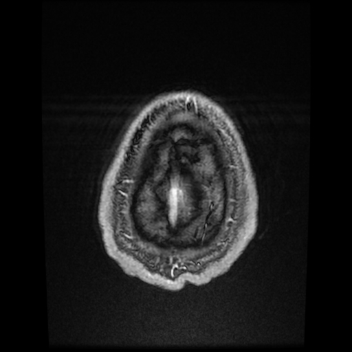 Cerebral cavernous venous malformation (Zabramski type II) (Radiopaedia 85511-101198 Axial T1 C+ fat sat 11).jpg