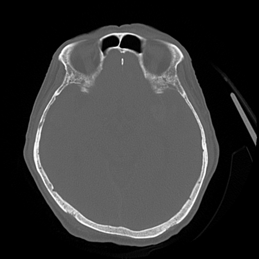 Cerebral contusions, subarachnoid hemorrhage and subdural hygromas (Radiopaedia 55399-61827 Axial bone window 23).png