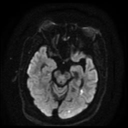 Cerebral embolic infarcts (embolic shower) (Radiopaedia 49837-55108 Axial DWI 78).jpg