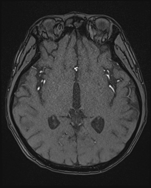 File:Cerebral embolic infarcts (embolic shower) (Radiopaedia 72391-82921 Axial MRA 85).jpg