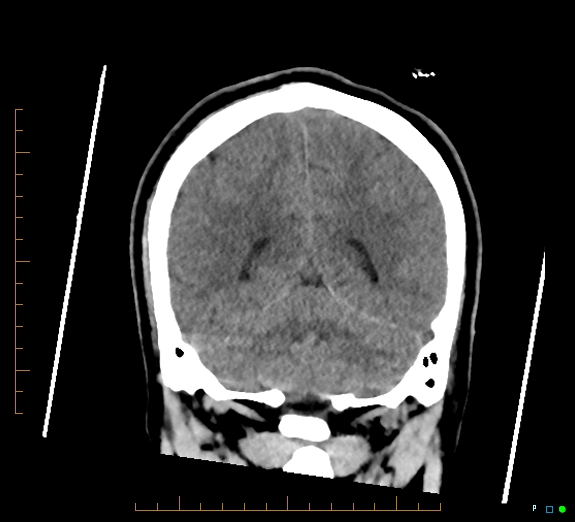 Cerebral fat embolism (Radiopaedia 85521-101220 Coronal non-contrast 45).jpg