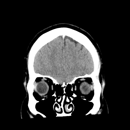 File:Cerebral hemorrhage secondary to arteriovenous malformation (Radiopaedia 33497-34561 C 13).png