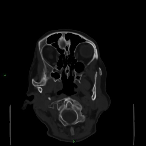 Cerebral metastases - breast primary (Radiopaedia 77653-89857 Axial bone window 9).jpg
