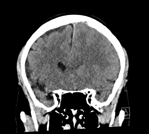 Cerebral metastases - testicular choriocarcinoma (Radiopaedia 84486-99855 Coronal C+ delayed 22).jpg