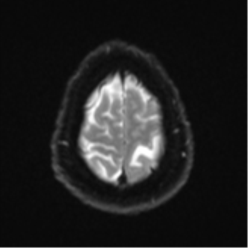 Cerebral metastases mimicking multifocal glioblastoma (Radiopaedia 50843-56353 Axial DWI 24).png