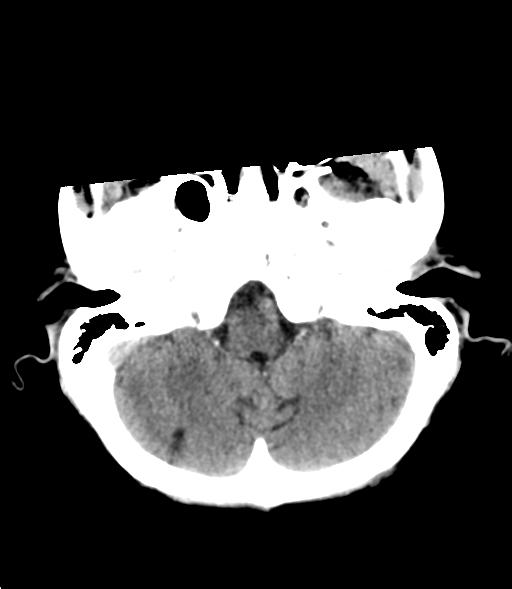 File:Cerebral metastasis (Radiopaedia 46744-51247 Axial non-contrast 6).png
