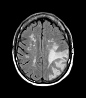 File:Cerebral metastasis (Radiopaedia 46744-51248 Axial FLAIR 20).png