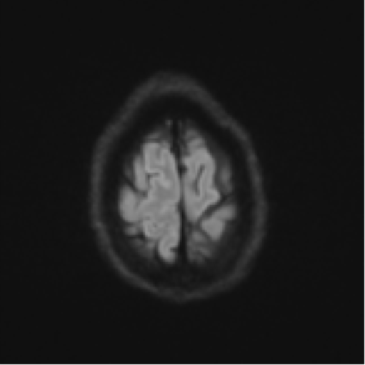 Cerebral metastasis - melanoma (Radiopaedia 54718-60954 Axial DWI 57).png