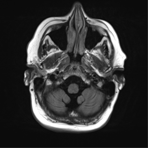 File:Cerebral metastasis mimicking glioblastoma (Radiopaedia 69155-78937 Axial FLAIR 6).png