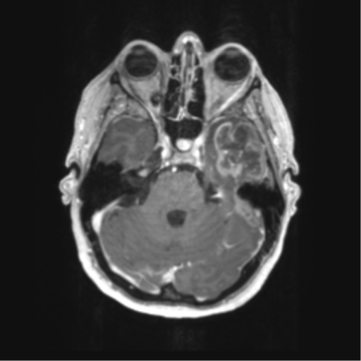 File:Cerebral metastasis mimicking glioblastoma (Radiopaedia 69155-78937 Axial T1 C+ 16).png