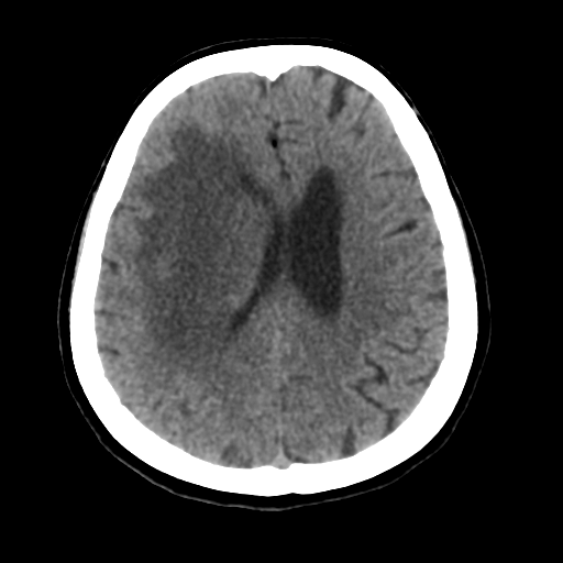 Cerebral metastasis to basal ganglia (Radiopaedia 81568-95412 Axial non-contrast 42).png