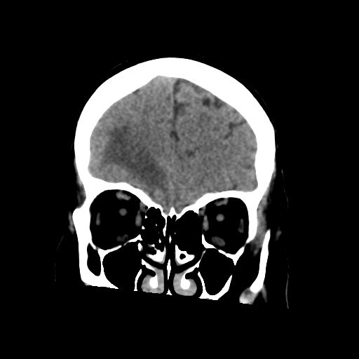 Cerebral metastasis to basal ganglia (Radiopaedia 81568-95412 Coronal non-contrast 19).png