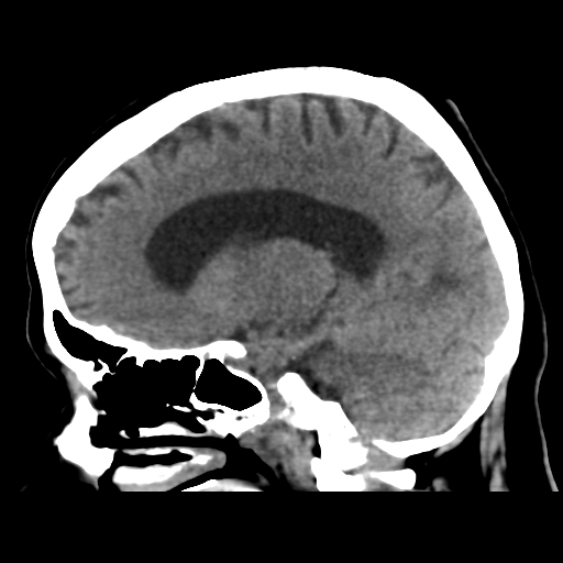 Cerebral metastasis to basal ganglia (Radiopaedia 81568-95412 E 37).png