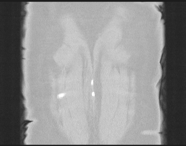 File:Cerebral metastasis to basal ganglia (Radiopaedia 81568-95414 Coronal lung window 79).png