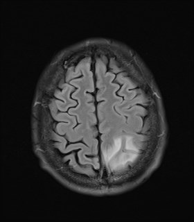 File:Cerebral toxoplasmosis (Radiopaedia 43956-47461 Axial FLAIR 19).jpg