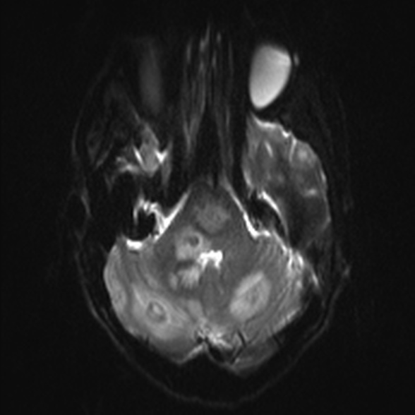 Cerebral toxoplasmosis (Radiopaedia 53993-60132 Axial DWI 7).jpg