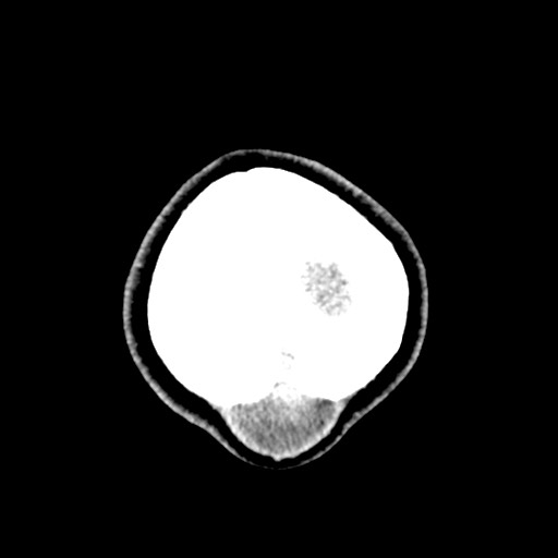 File:Cerebral tuberculosis with dural sinus invasion (Radiopaedia 60353-68018 Axial non-contrast 62).jpg