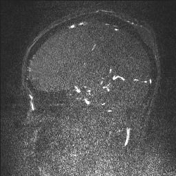 Cerebral tuberculosis with dural sinus invasion (Radiopaedia 60353-68090 Sagittal MRV 62).jpg