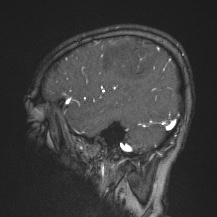 Cerebral venous infarction - hemorrhagic (Radiopaedia 81625-95505 Sagittal MRV 18).jpg